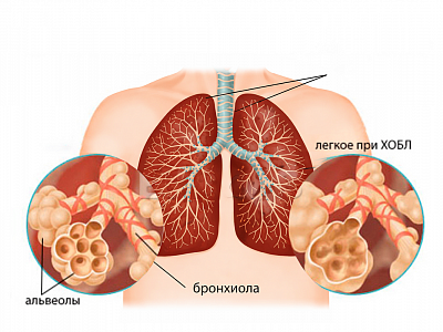 Кашлево-обморочный синдром у пациента с тяжелым обострением хронической обструктивной болезни легких